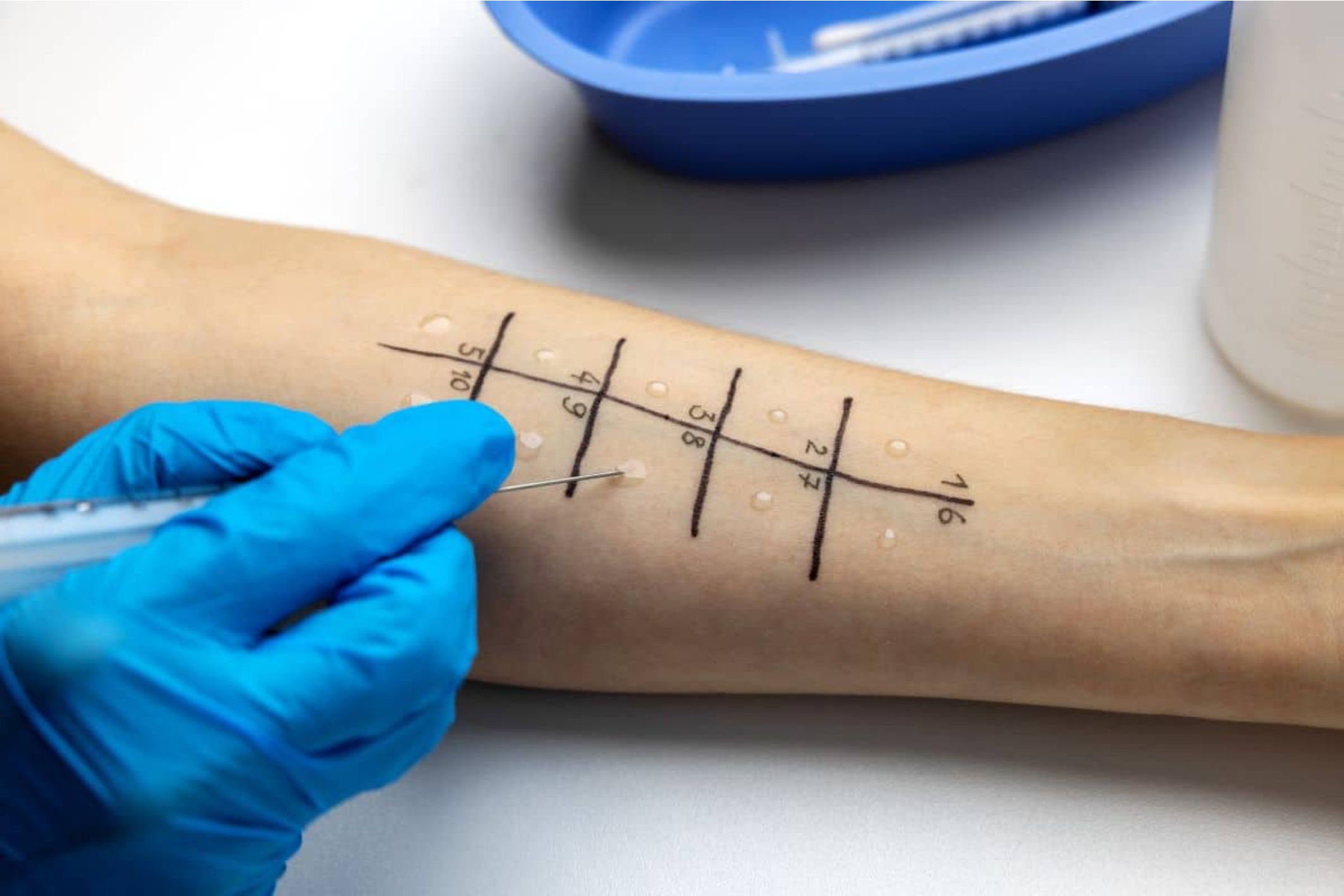 Skin Prick Test Allergy
